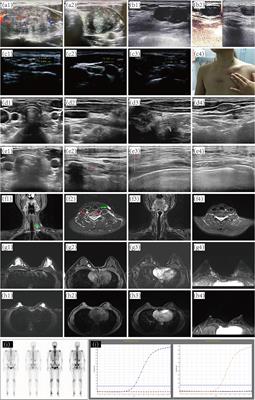 Case Report: Implantation of Dedifferentiated to Poorly Differentiated Thyroid Carcinoma After Endoscopic Thyroid Surgery